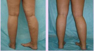 how the first stage of varicose veins manifests itself