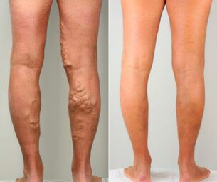 Stages of leg varicose veins
