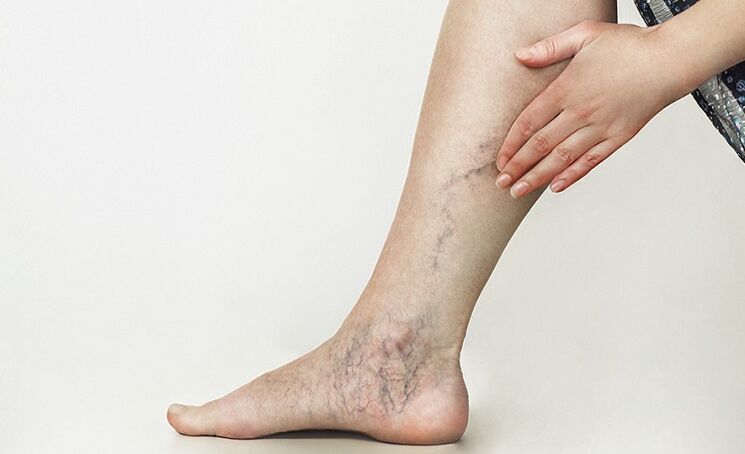 varicose veins and treatment with folk remedies
