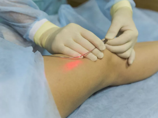 The treatment of varicose veins laser