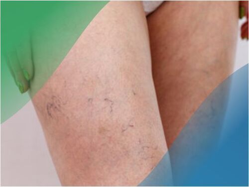 The vascular network in the legs is a symptom of varicose veins