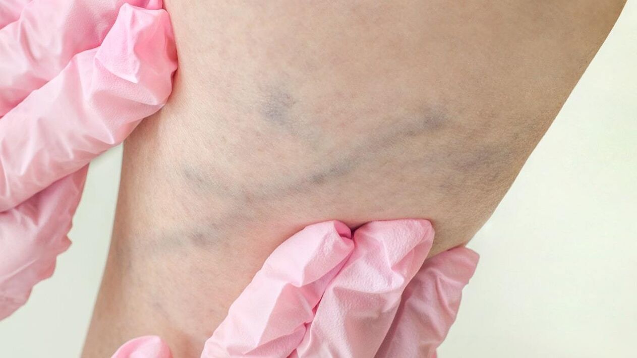 Protruding veins in the legs are a symptom of varicose veins. 