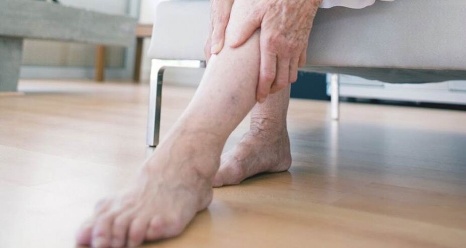 Varicose veins of the lower extremities due to venous valve failure