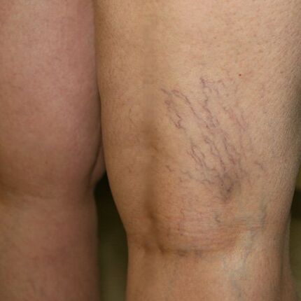 A network of veins on the lower limbs is a sign of varicose veins