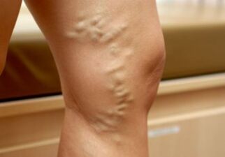 Varicose veins on a woman's leg