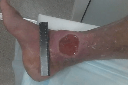 The complications of the varicos