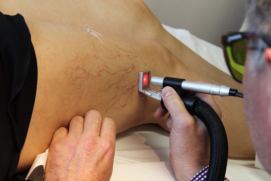 Laser formation