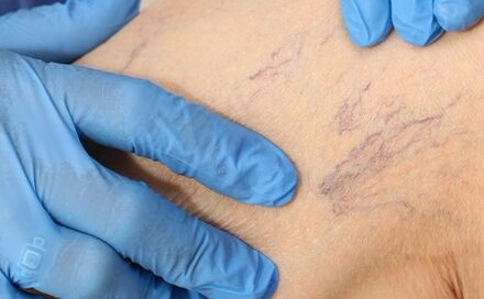 The symptoms of varicoosa