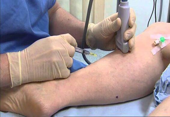 Treatment of varicos