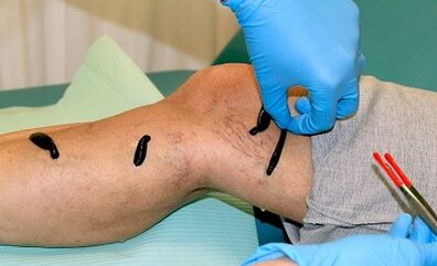 Hirudotherapy for varicoosians
