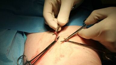 Flebectomy for varicos