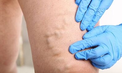 Varikoos veins on the legs