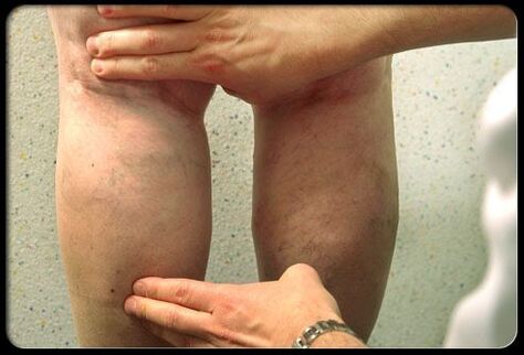 The doctor examines the legs with varicos