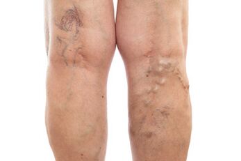 varicose veins of lower limbs