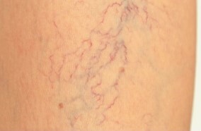 In the early stages of varicose veins