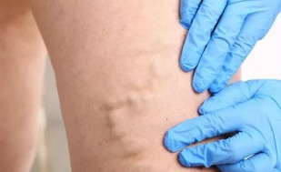 The treatment of varicose veins with the help of a bioadhesive
